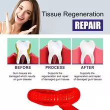 Laser Treatment for Periodonta - Teeth Whitening Laser Treatment review and price