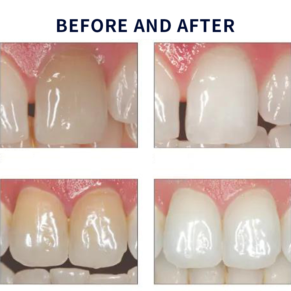 Opalescence Whitening 20% PF 2 - Teeth Whitening Doctor review and price