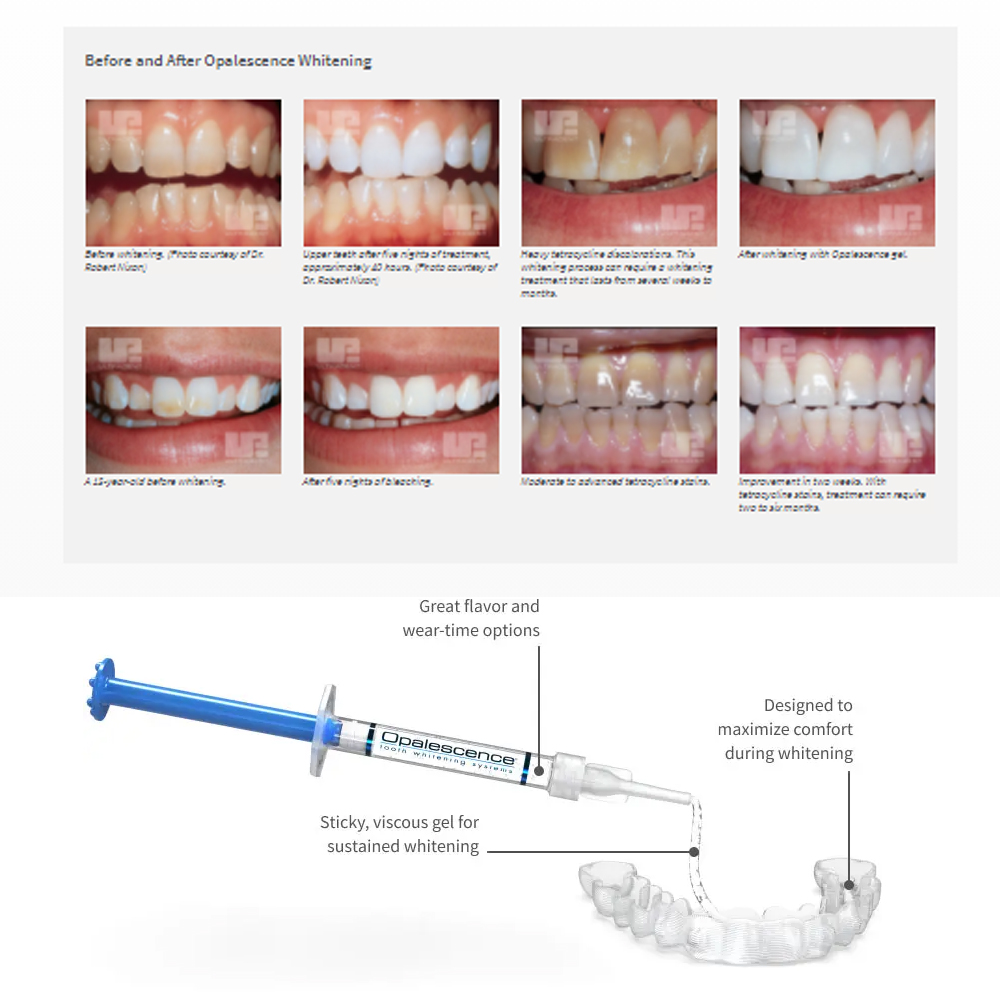 Opalescence Whitening 20% PF 2 - Teeth Whitening Doctor review and price
