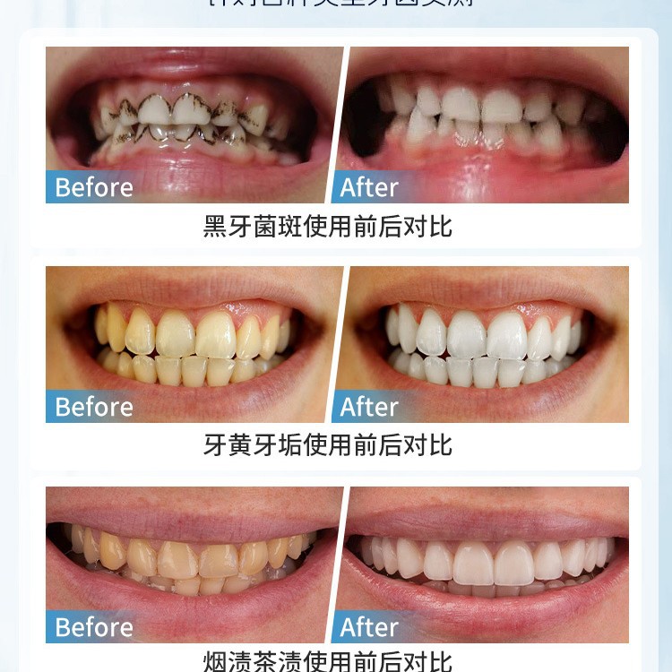 Japan Manual Tooth Stain Remov - Teeth Whitening In Japan review and price