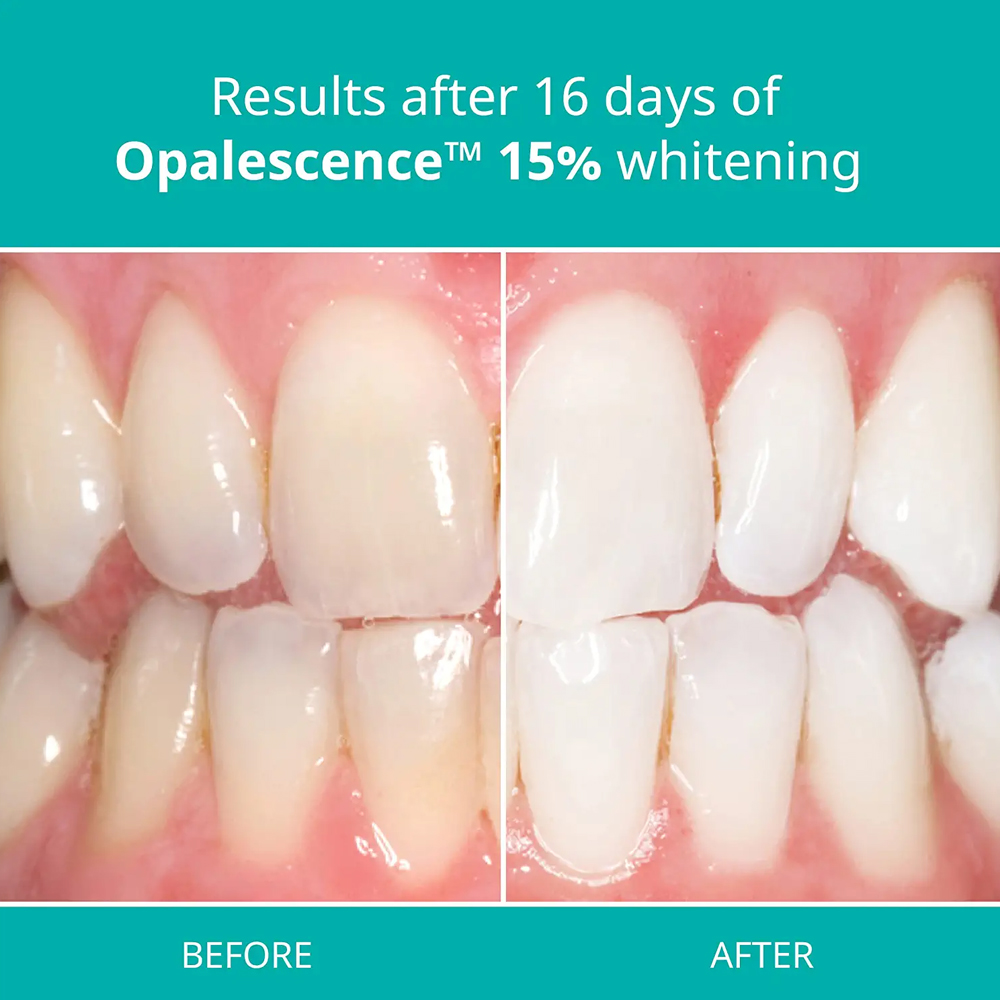 Opalescence PF 15% Refill Kit  - Teeth Whitening Gel Opalescence review and price